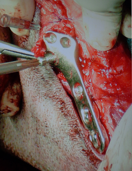 TPLOのプレートに、ロッキングスクリューを装着している所