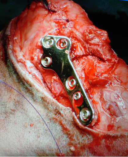 TPLOのプレートに、すべてのロッキングスクリューが装着された所