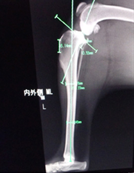 術前に手術の角度を決める計測