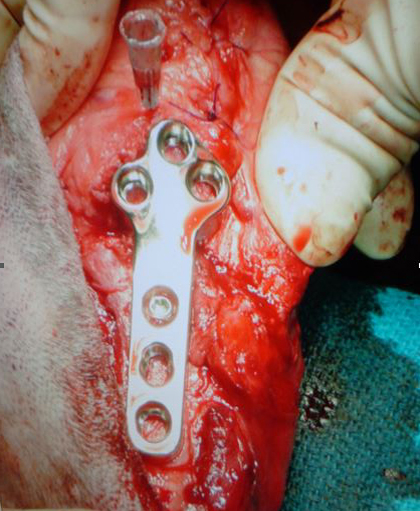 シンセス(Synthes)のTPLO用のプレートを装着している所