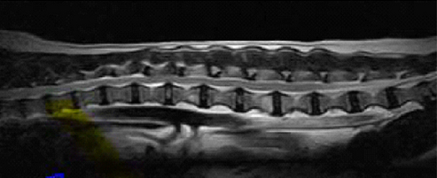 造影なしのT2強調画像02