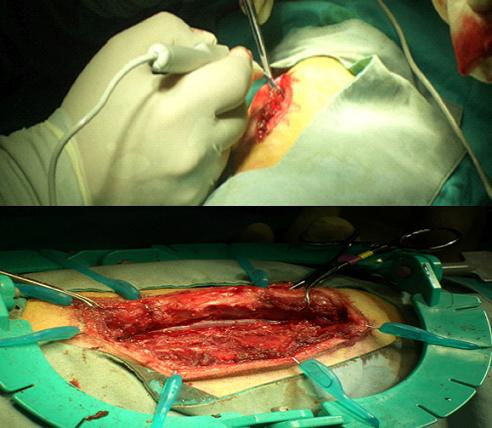 半側椎弓切除術・背側椎弓切除術