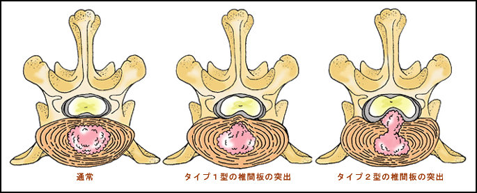 タイプ1型とタイプ2型