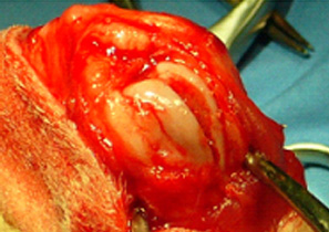 滑車の溝を彫る形成術