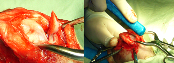 くさび型陥没形成術